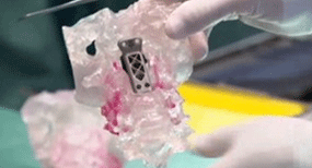 3D-printed vertebrae part